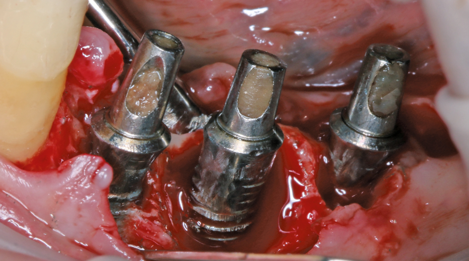 Klinisches Bild einer Periimplantitis.