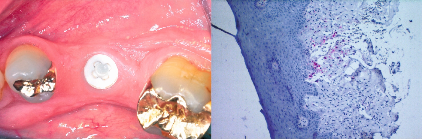 Entzündungsfreie periimplantäre Mukosa um zweiteiliges verschraubbares Zirkonimplantat (ZERAMEX XT) in regio 36. Histologie der periimplantären Mukosa um Zirkonimplantat ohne Entzündungsreaktion.