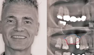 Postoperative Aufnahme des Patienten nach schmerzfreier Behandlung.