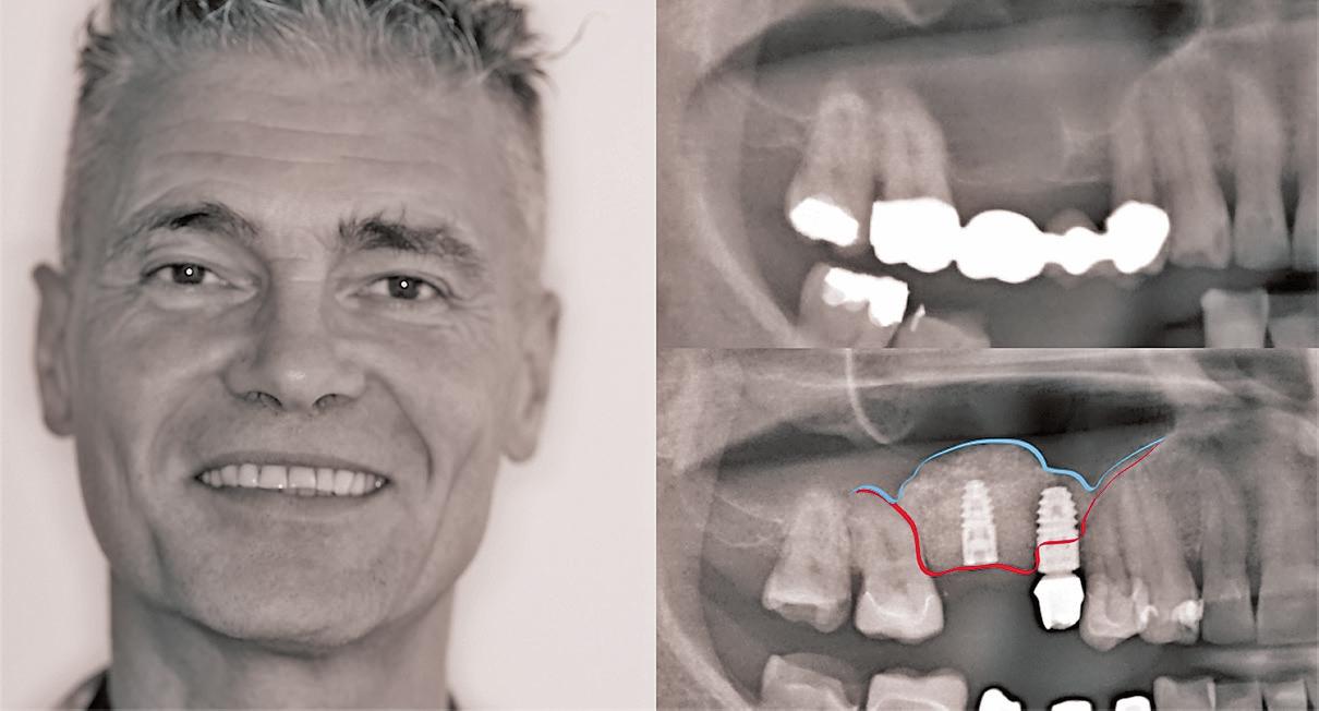 Postoperative Aufnahme des Patienten nach schmerzfreier Behandlung.