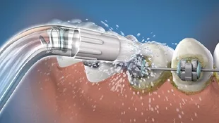 Verschiedene Aufsätze der Waterpik® Munddusche decken die individuellen Bedürfnisse des Patienten ab.