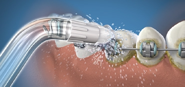 Verschiedene Aufsätze der Waterpik® Munddusche decken die individuellen Bedürfnisse des Patienten ab.