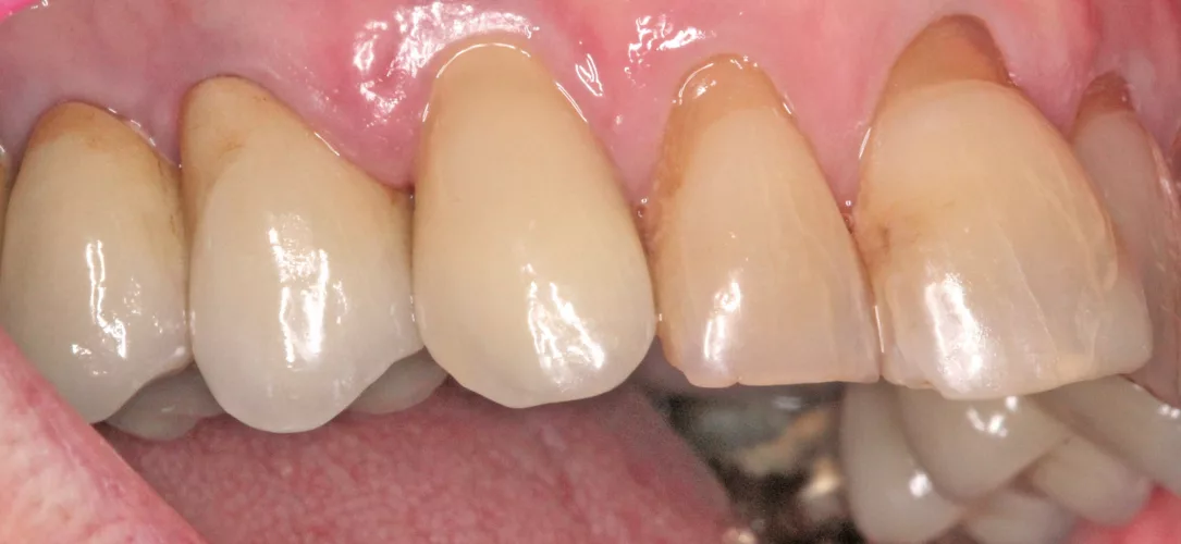 Optimale Papillenregeneration, insbesondere mesial.
