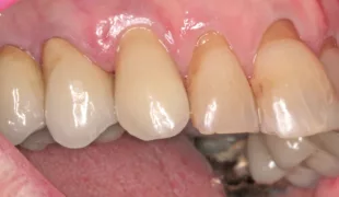 Optimale Papillenregeneration, insbesondere mesial.