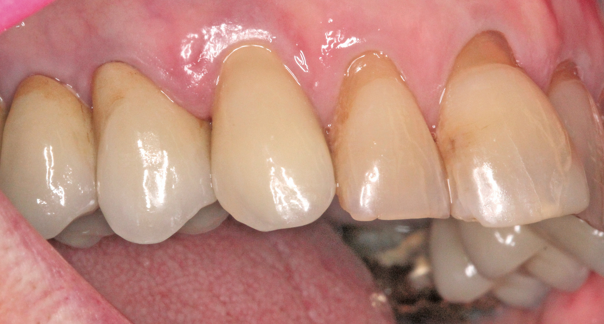 Optimale Papillenregeneration, insbesondere mesial.
