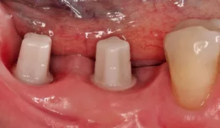 Gesunde periimplantäre Weichgewebsverhältnisse um das ceramic.implant in regio 36 und 37 (Fallbeispiel aus der klinischen Studie, Prof. Dr. Wael Att, Universität Freiburg).