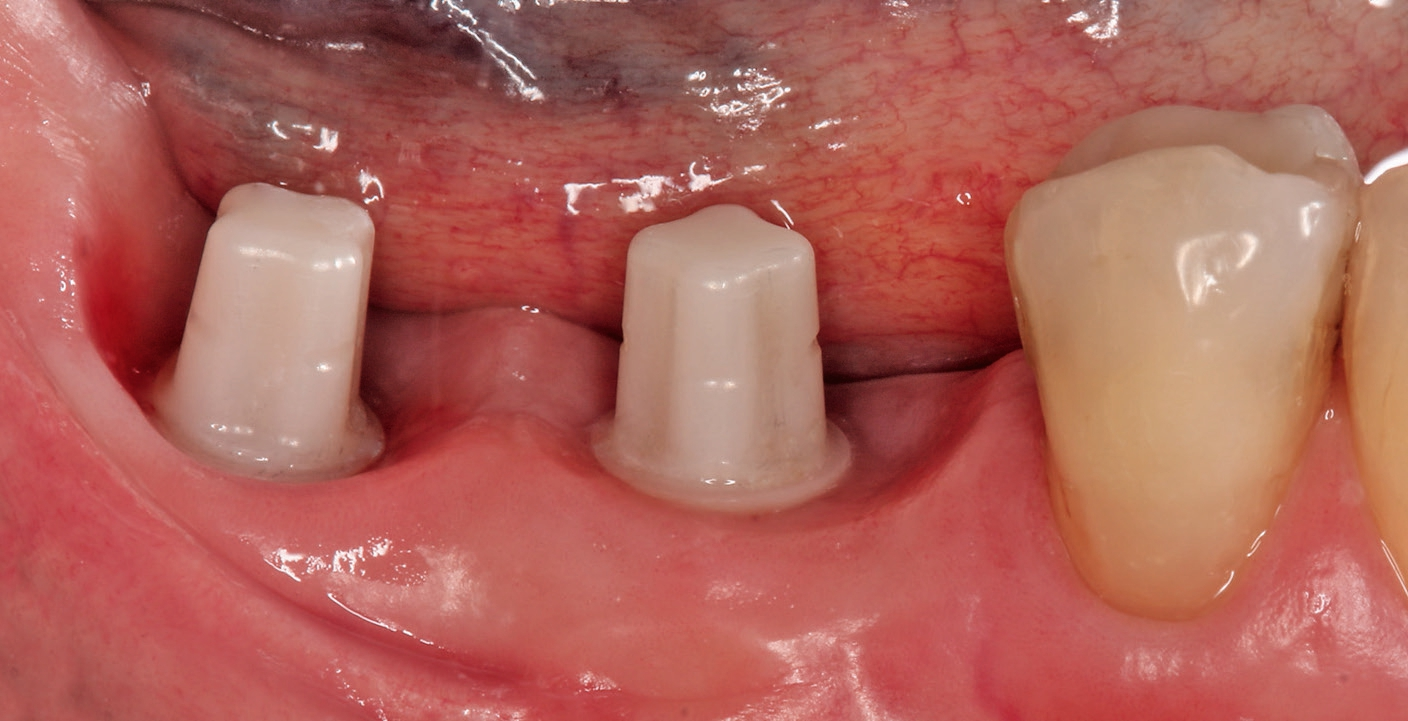Gesunde periimplantäre Weichgewebsverhältnisse um das ceramic.implant in regio 36 und 37 (Fallbeispiel aus der klinischen Studie, Prof. Dr. Wael Att, Universität Freiburg).