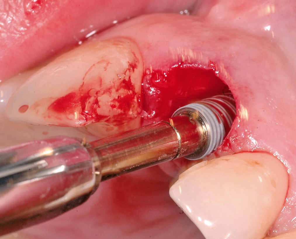Sofortimplantation mit einem NobelActive-Implantat.