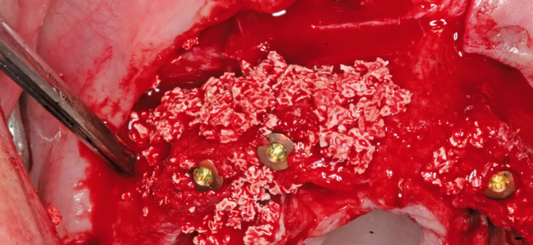 Augmentation des Osteotomiespaltes.