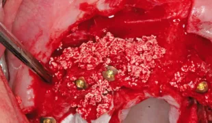 Augmentation des Osteotomiespaltes.