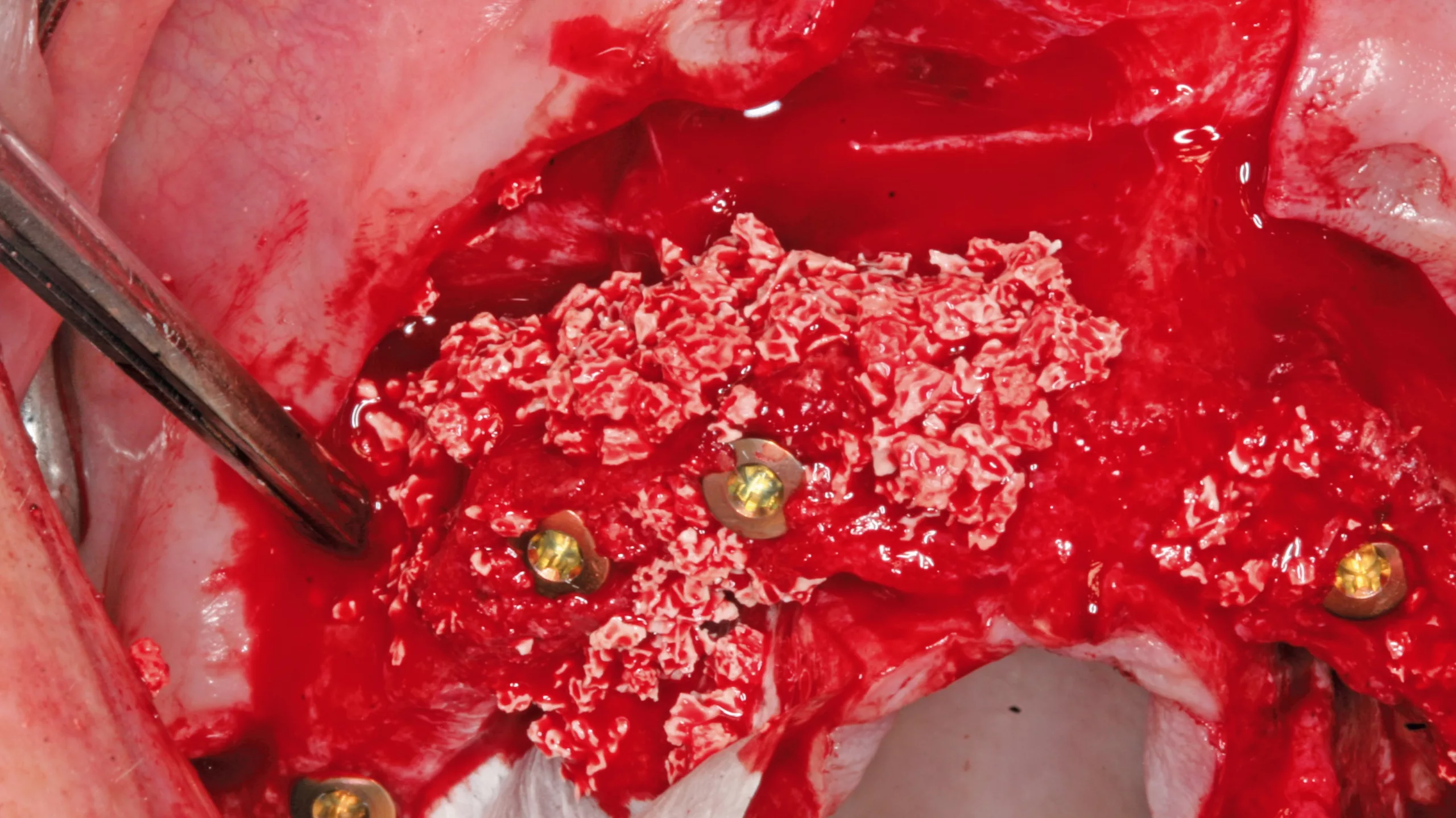 Augmentation des Osteotomiespaltes.