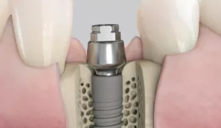 Acuris, das neue konometrische Konzept zur sicheren Befestigung der Krone im abschließenden implantat-prothetischen Behandlungsschritt mittels Friktion, anstelle von Schrauben oder Zement.