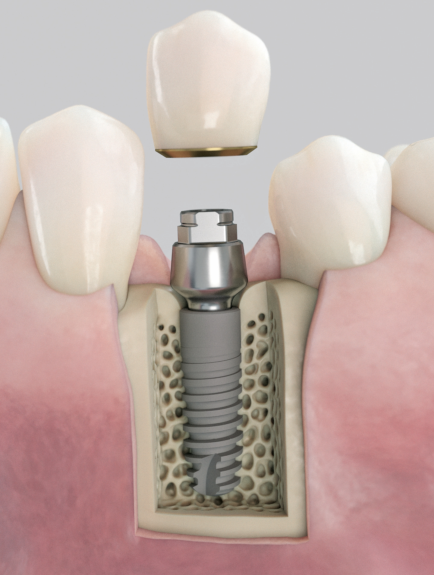 Acuris, das neue konometrische Konzept zur sicheren Befestigung der Krone im abschließenden implantat-prothetischen Behandlungsschritt mittels Friktion, anstelle von Schrauben oder Zement.