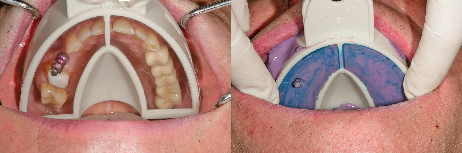Implantatabdruck