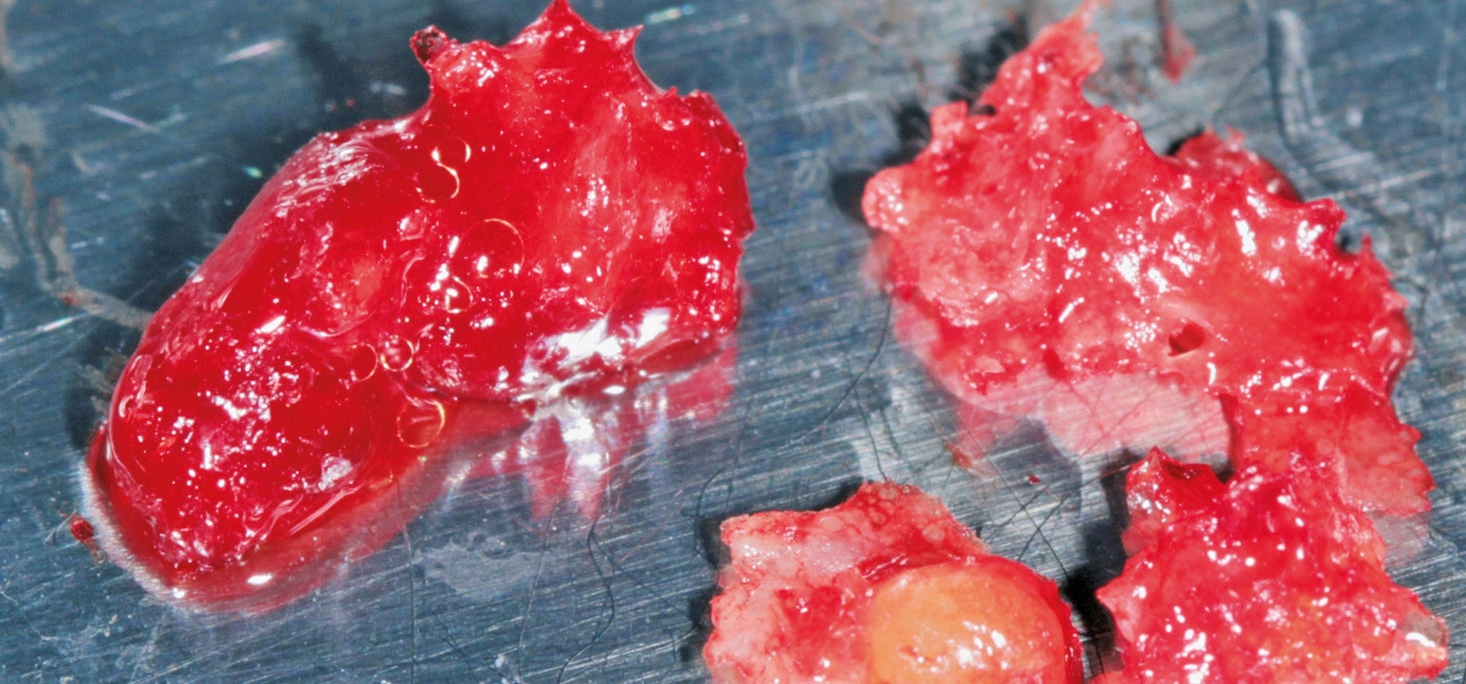 Abb. 1: Klinisches Bild nach Excochleation einer KO. Gut erkennbar die fettigen, gelben Anteile im nekrotischen Material und „Fettaugen“ des Blutes.