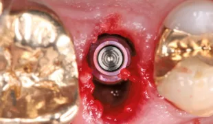Das 2 mm subkrestal und in palatinalem Bereich inserierte Implantat.