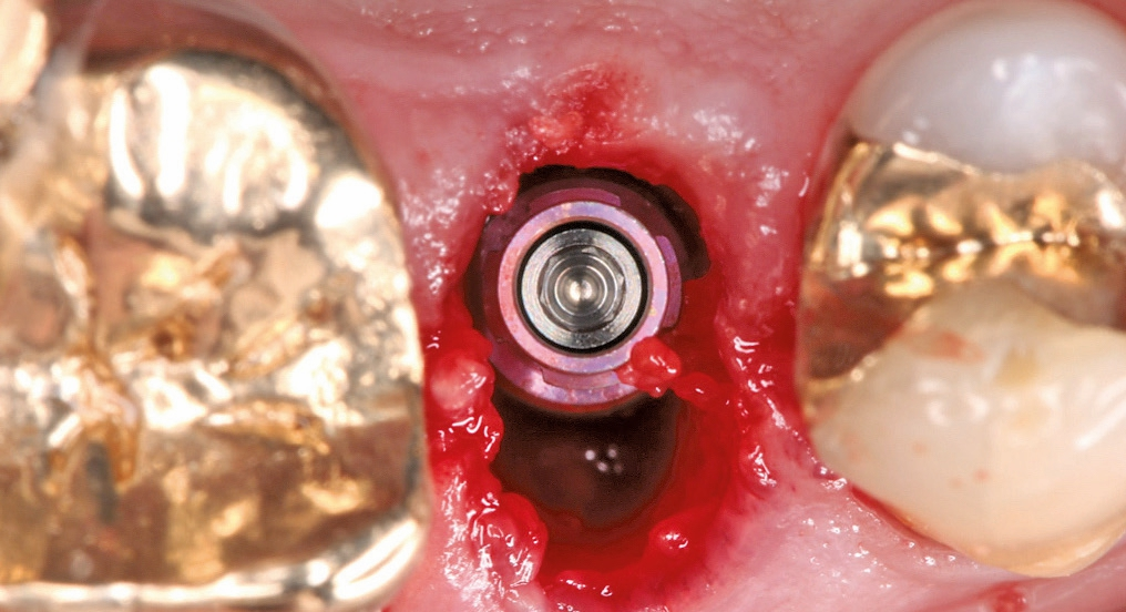 Das 2 mm subkrestal und in palatinalem Bereich inserierte Implantat.