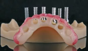 CAD/CAM-gestützt gefertigtes Provisorium für die Sofortversorgung, realisiert anhand der navigierten Implantatplanung.