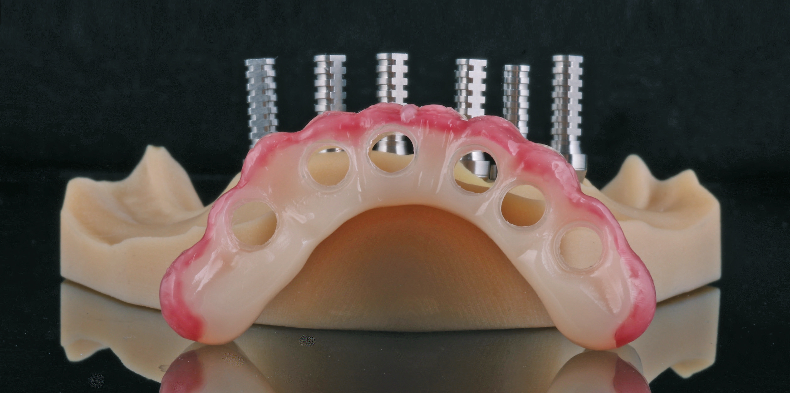 CAD/CAM-gestützt gefertigtes Provisorium für die Sofortversorgung, realisiert anhand der navigierten Implantatplanung.