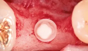 Die abschließende Position des ceramic.implant von okklusal.