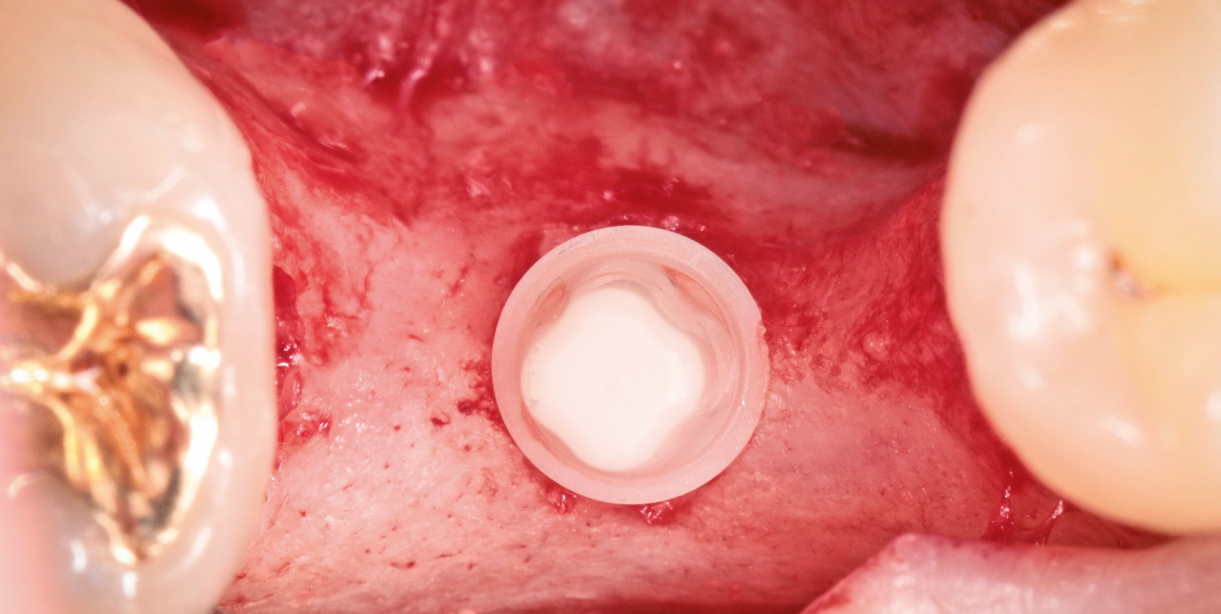 Die abschließende Position des ceramic.implant von okklusal.
