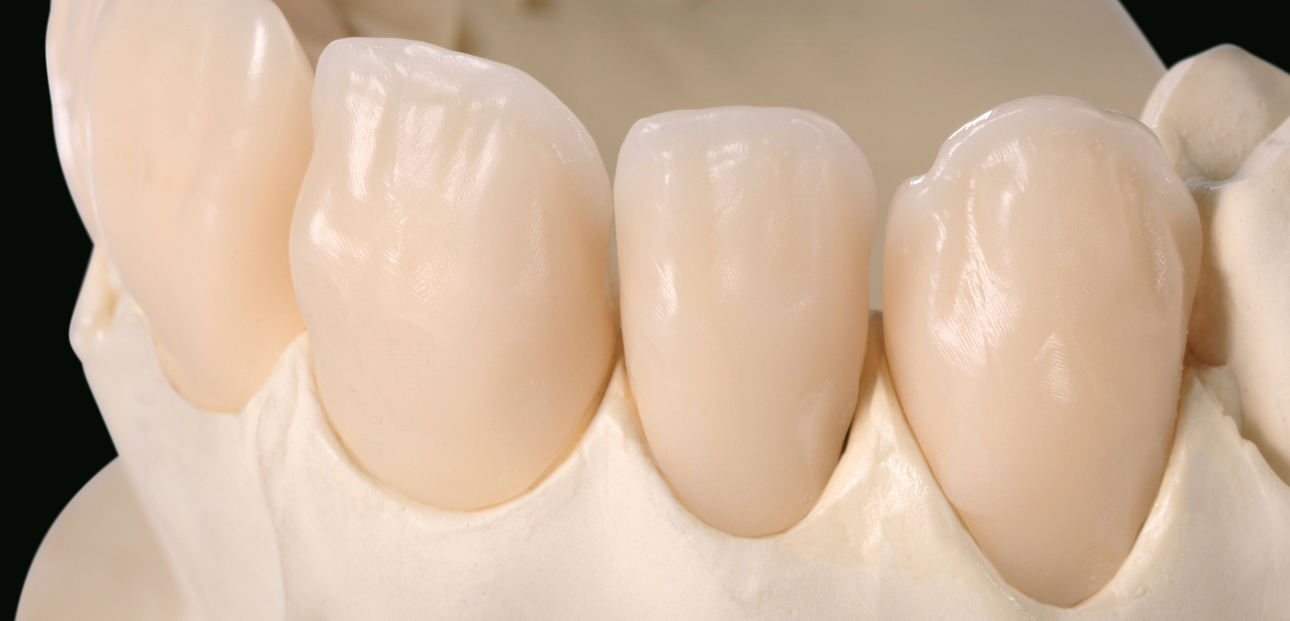 Ceramill A-Temp: Krone, Cut-back.