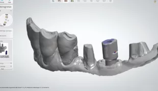 Abb. 1: Digitales Modell auf Basis eines Intraoralscans.