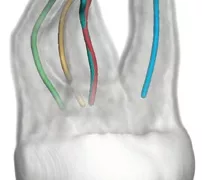 Eine 3D-Darstellung aller Wurzelkanäle des betroffenen Zahns und ihrer genauen Verläufe erleichtert die Behandlungsplanung.