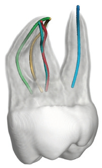 Eine 3D-Darstellung aller Wurzelkanäle des betroffenen Zahns und ihrer genauen Verläufe erleichtert die Behandlungsplanung.