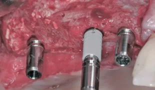 Die Insertion der ANKYLOS Implantate.
