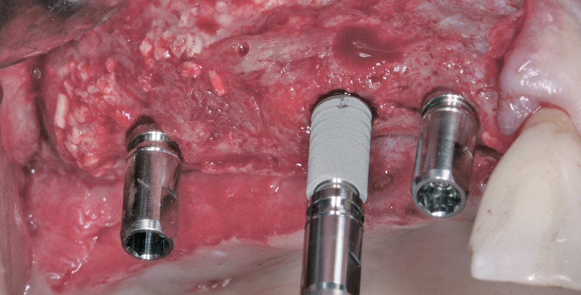 Die Insertion der ANKYLOS Implantate.