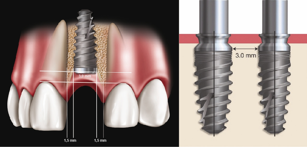 Abb. 1a: In der apiko-koronalen Richtung sollten Implantate 3,0 mm vom freien Zahnfleischrand entfernt eingesetzt werden. Mesial-distal sollten Implantate mindestens 1,5 mm von benachbarten Zähnen entfernt eingesetzt werden. Abb. 1b: Zwischen benachbarten Implantaten sollte ein 3,0 mm- Abstand vorliegen.