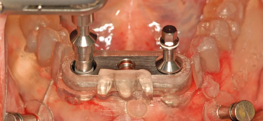 Insertion der Implantate.
