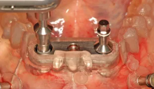 Insertion der Implantate.