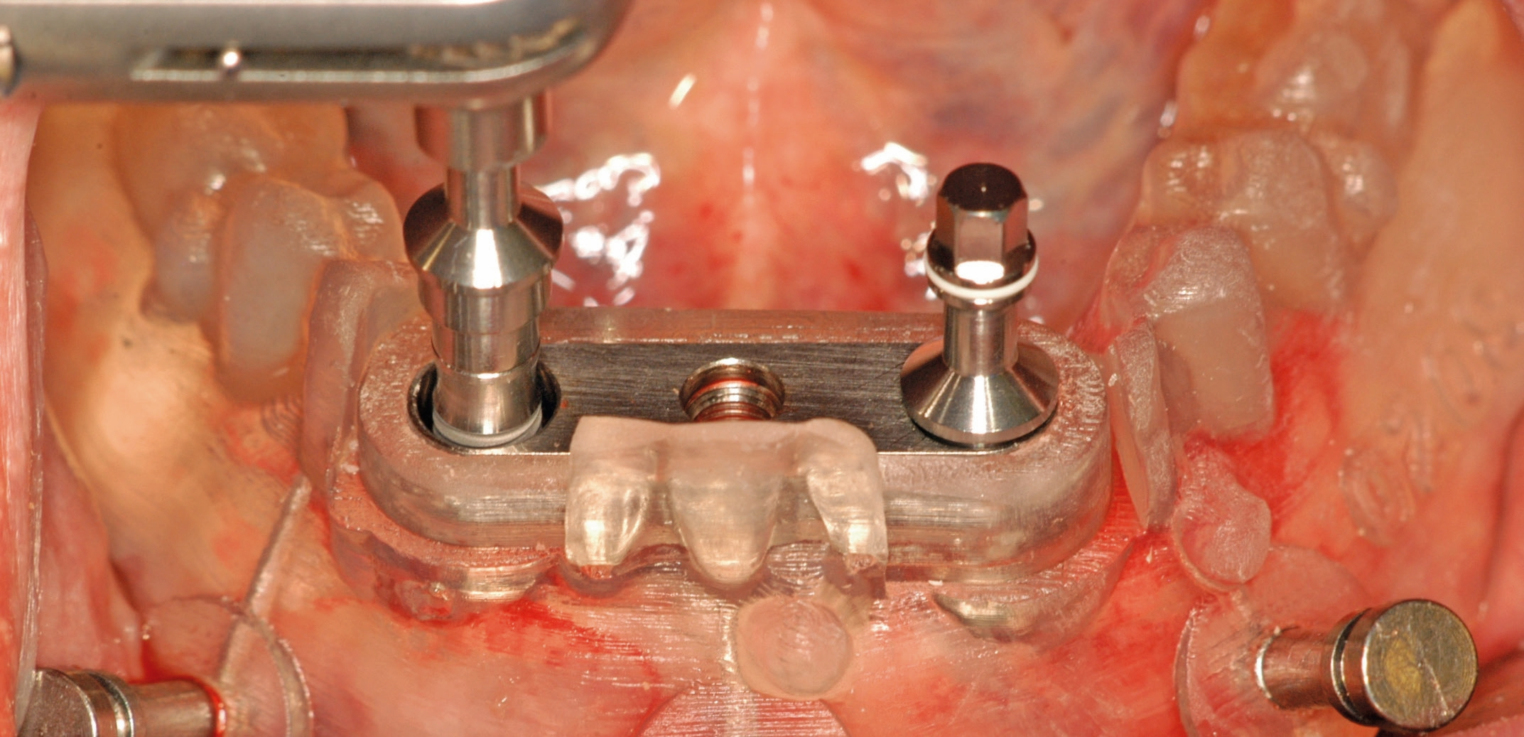 Insertion der Implantate.