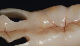 Vorbehandlung der zu verklebenden Zirkonfläche.