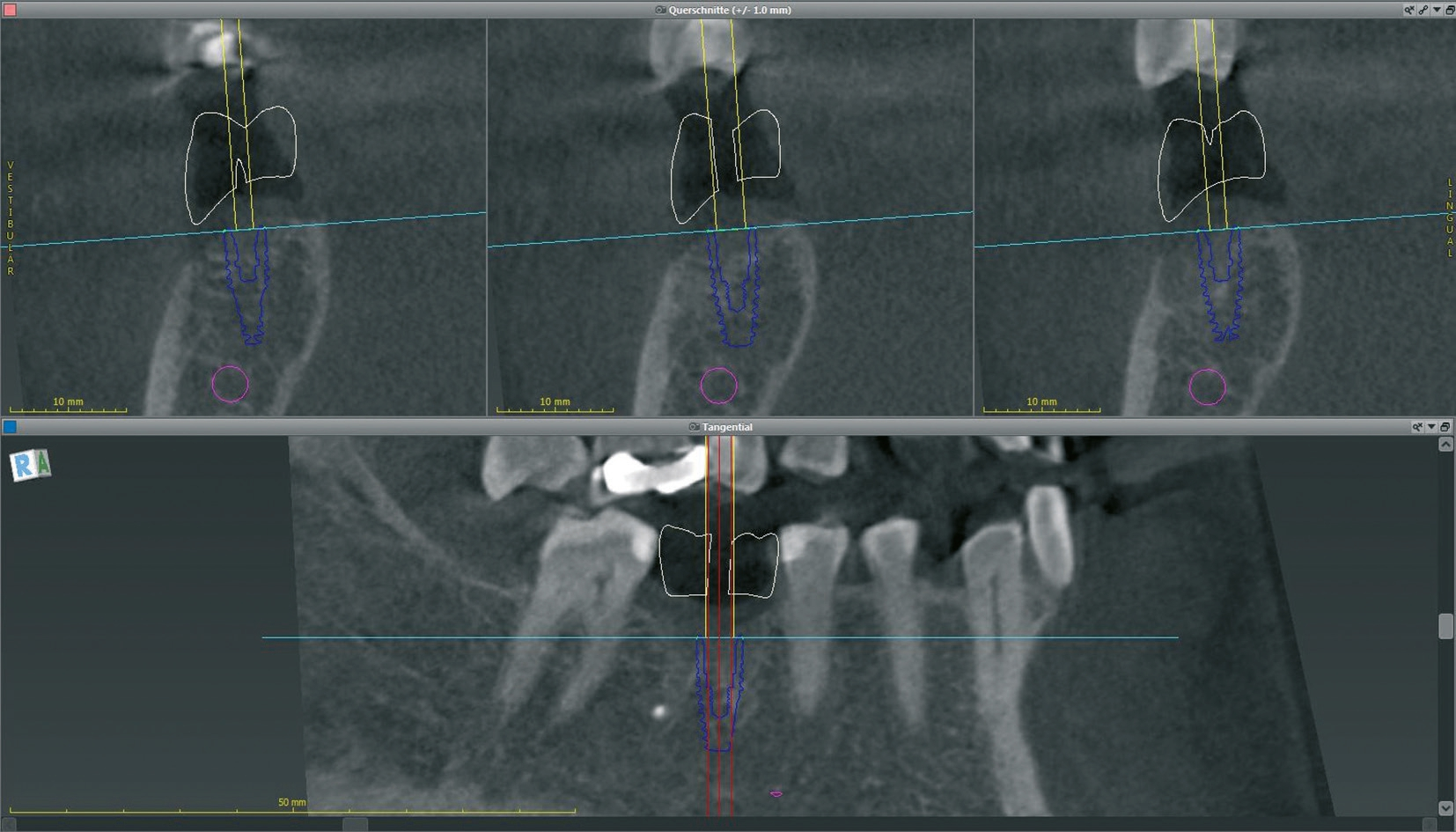 Abb. 2: Beurteilung der prothetisch orientierten Implantatposition in Querschnitts- und Tangentialachse (coDiagnostiX 9.12, Dental Wings).