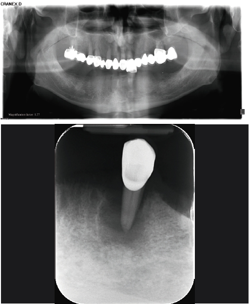 Abb. 1 und 2: Ausgangs-OPG, Zahnfi lm Zahn 33.