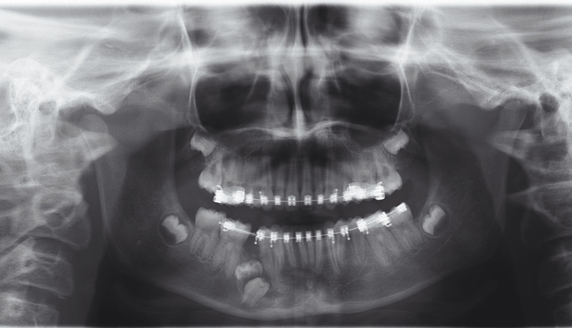 Abb. 1a: Panoramaschichtaufnahme. Darstellung einer überzähligen Zahnanlage und eines retinierten Zahnes 45. Unklarer Verlauf des Nervus alveolaris inferior in Bezug auf retinierten Zahn 45.