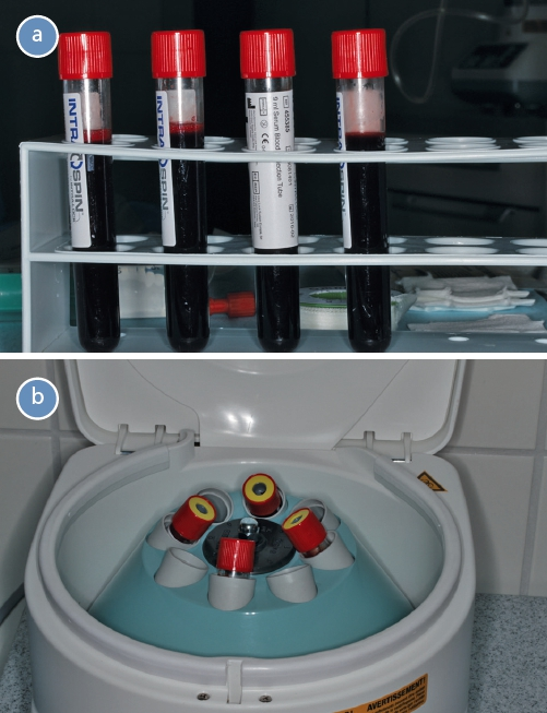 Abb. 1a und b: Mit Patientenblut gefüllte Blutentnahmeröhrchen vor der Zentrifugation (a) und Beladung der Zentrifuge mit den Blutentnahmeröhrchen (b).