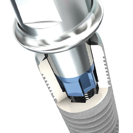 Implantatsystem SICvantage® max.