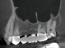 Abb. 1: Sagittale CBCT-Aufnahme vor der Behandlung.