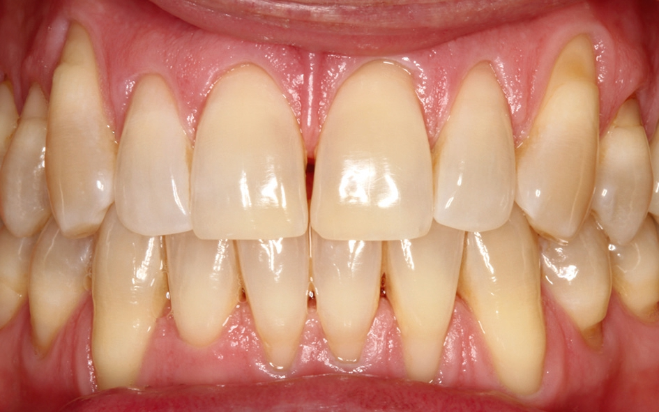 Abb. 1: Präoperative klinische Situation. Mandibuläre und maxilläre Miller-Klasse I gingivale Rezessionen mit gesundem interdentalen Gewebe.