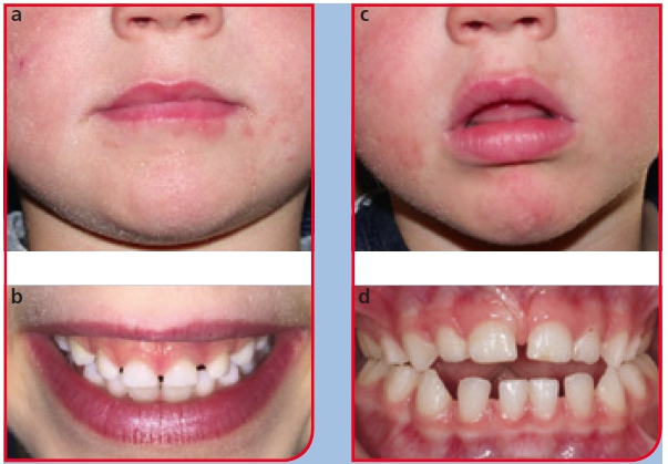 Abb. 1: Korrelation von Bisslage und Aussehen bzw. Ausstrahlung. a: Physiognomie bei Eugnathie (Foto: Sabine Fuhlbrück) b: Neutralbiss (Foto Dr. Andrea Thumeyer) c: Physiognomie bei offenem Biss (Foto: Sabine Fuhlbrück) d: Frontal offener Biss und lateraler Kopfbiss im Milchgebiss (Foto: Dr. Jens Bock)