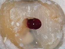 Abb. 1: Die Trepanation der Pulpakammer erfolgte initial mit einer Diamantkugel.