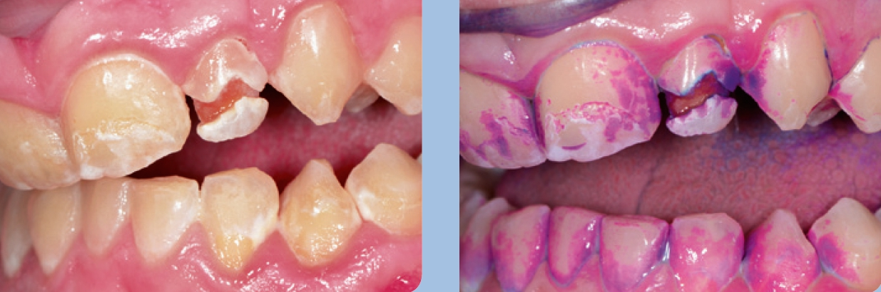 Abb. 1 u. 2: Klinisches Bild dentaler Plaque und aktiver kariöser Läsionen bei einem 18-jährigen Patienten (klinische Situation – oben; nach Färbung mit Plaquefärbelösung [Mira-2-Ton, Hager & Werken] – unten) (Quelle: A. Felten).