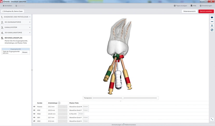 Abb. 1: Mithilfe der 3D-Endo-Software lassen sich auf Basis von 3D-Bilddaten sowohl die Zugangskavität als auch die benötigten Instrumente im Voraus exakt planen.
