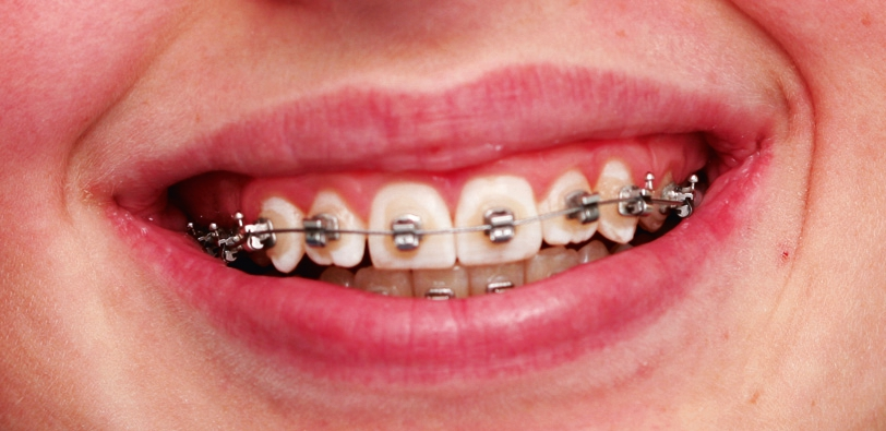 Abb. 1: Brackets erschweren die Zahn- und Mundpflege.