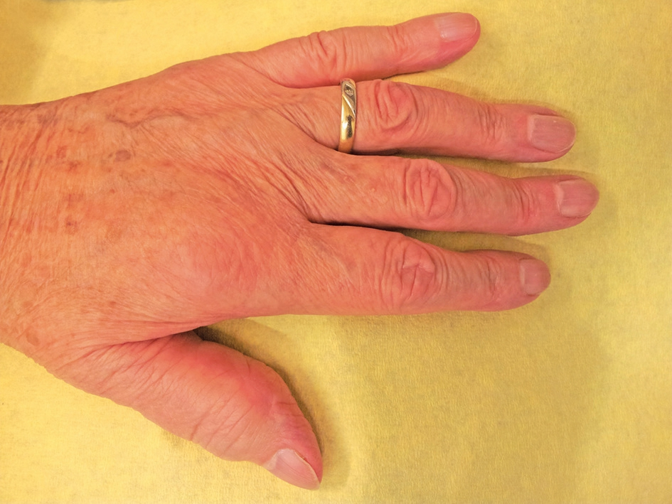 Abb. 2: Deutlich erkennbar sind die Gelenkschwellungen des linken Zeigefingers und Daumens.