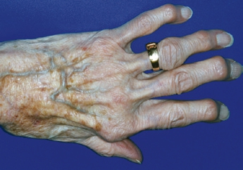 Abb. 1: Einschränkung der manuellen Geschicklichkeit durch Polyarthrose. Bei dieser 91-jährigen, zu Hause lebenden Patientin wurde die Feinmotorik durch das Gehen an zwei Stöcken zusätzlich beeinträchtigt.